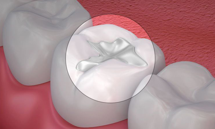a composite filling on a tooth