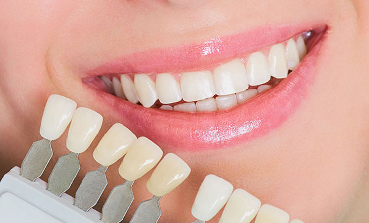 Choosing the color and shape for a dental crown