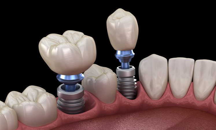 Dental implant restorations