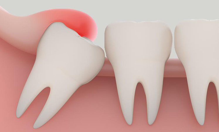 An impacted wisdom tooth causing pain