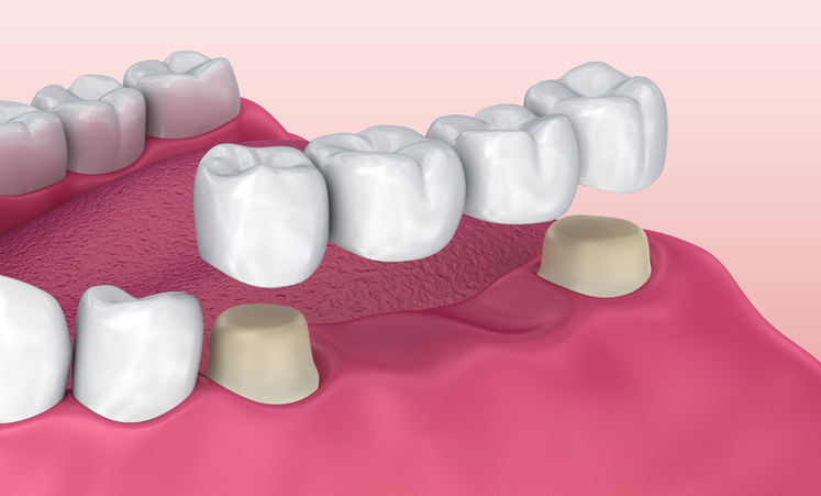 How a dental bridge works