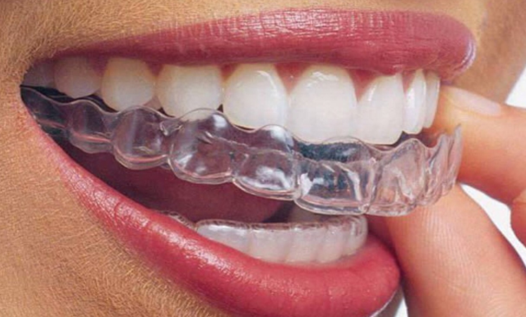 Mouthguard being placed over the teeth
