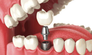 Single tooth dental implants in the jaw