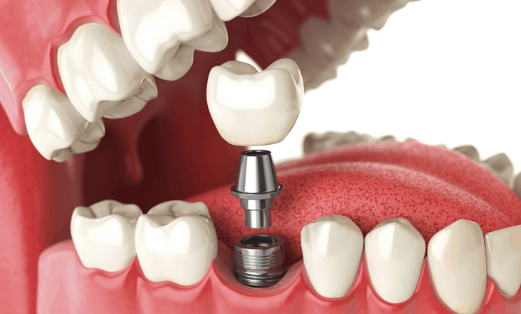 Single Tooth Implant in Daytona Beach