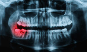 How an impacted wisdom tooth appears on x-rays during preventative dentistry